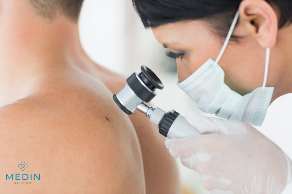 znamię skórne oglądane dermatoskopem