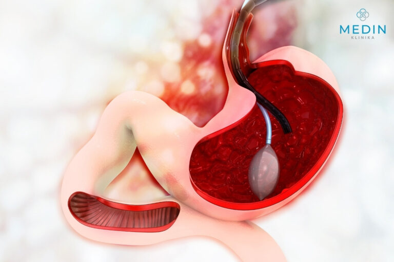 dieta przed balonem żołądkowym